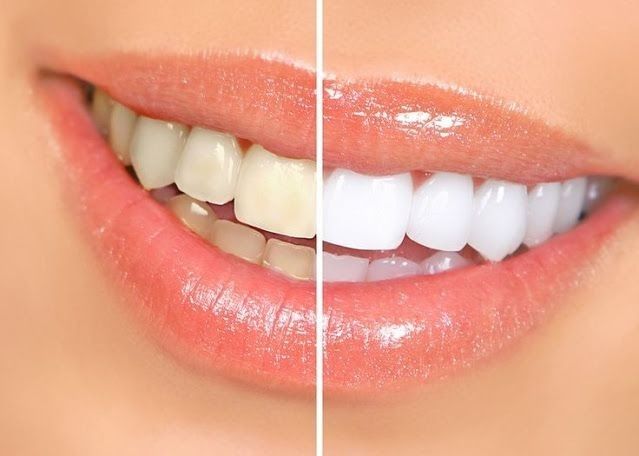 5-Remedios-Casero-Eficaces-Para-Blanquear-los-Dientes-Amarillos